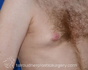 Male Breast Reduction (Gynecomastia)