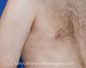 Male Breast Reduction (Gynecomastia)