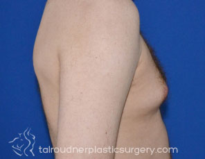 Male Breast Reduction (Gynecomastia)
