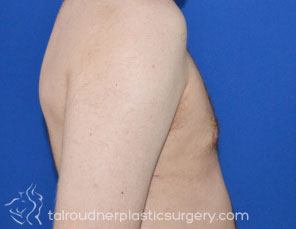 Male Breast Reduction (Gynecomastia)