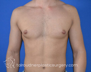 Male Breast Reduction (Gynecomastia)