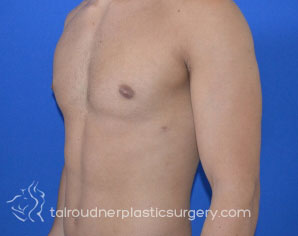 Male Breast Reduction (Gynecomastia)