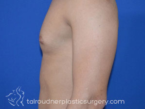 Male Breast Reduction (Gynecomastia)