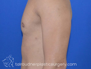 Male Breast Reduction (Gynecomastia)
