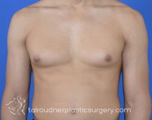 Male Breast Reduction (Gynecomastia)