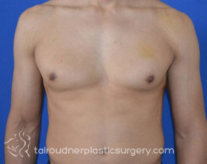 Male Breast Reduction (Gynecomastia)
