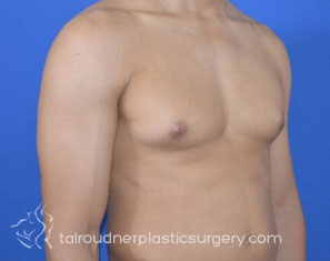 Male Breast Reduction (Gynecomastia)