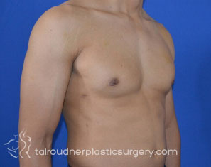 Male Breast Reduction (Gynecomastia)