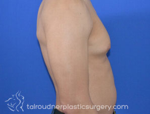 Male Breast Reduction (Gynecomastia)