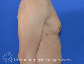Male Breast Reduction (Gynecomastia)