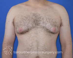 Male Breast Reduction (Gynecomastia)