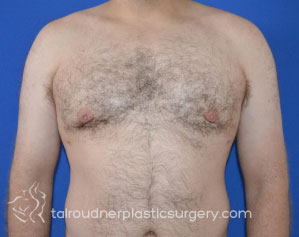 Male Breast Reduction (Gynecomastia)