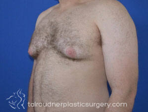 Male Breast Reduction (Gynecomastia)