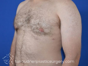 Male Breast Reduction (Gynecomastia)