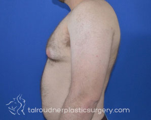 Male Breast Reduction (Gynecomastia)