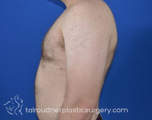 Male Breast Reduction (Gynecomastia)