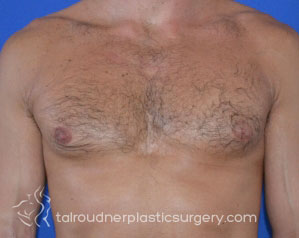 Male Breast Reduction (Gynecomastia)