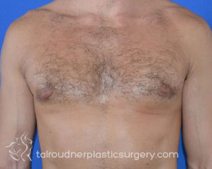 Male Breast Reduction (Gynecomastia)