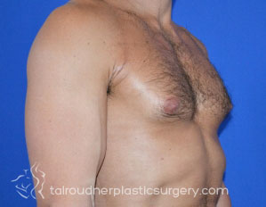 Male Breast Reduction (Gynecomastia)
