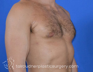 Male Breast Reduction (Gynecomastia)
