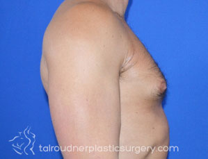 Male Breast Reduction (Gynecomastia)