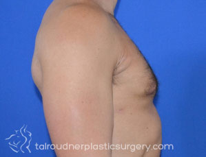Male Breast Reduction (Gynecomastia)
