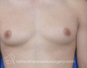 Male Breast Reduction (Gynecomastia)