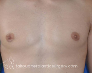 Male Breast Reduction (Gynecomastia)