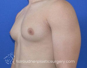 Male Breast Reduction (Gynecomastia)