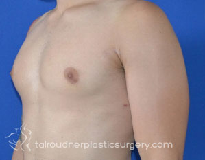 Male Breast Reduction (Gynecomastia)
