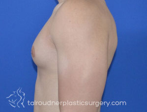 Male Breast Reduction (Gynecomastia)