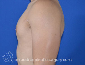 Male Breast Reduction (Gynecomastia)