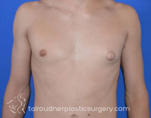 Male Breast Reduction (Gynecomastia)
