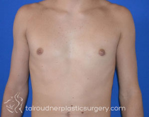 Male Breast Reduction (Gynecomastia)