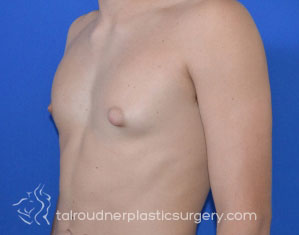 Male Breast Reduction (Gynecomastia)