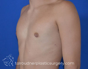 Male Breast Reduction (Gynecomastia)