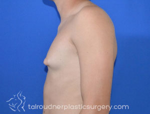 Male Breast Reduction (Gynecomastia)