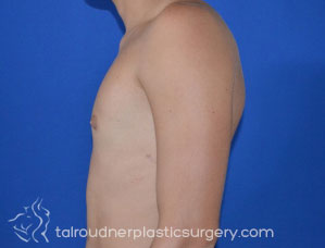 Male Breast Reduction (Gynecomastia)