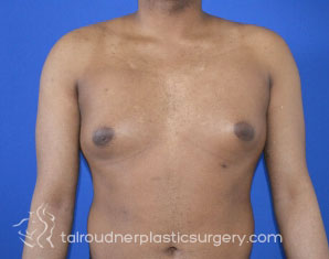 Male Breast Reduction (Gynecomastia)