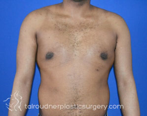 Male Breast Reduction (Gynecomastia)