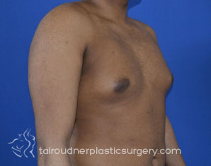 Male Breast Reduction (Gynecomastia)