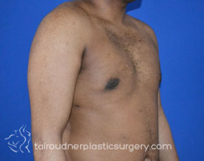 Male Breast Reduction (Gynecomastia)