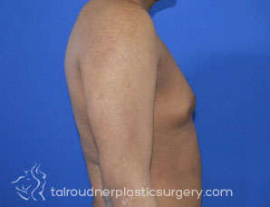 Male Breast Reduction (Gynecomastia)