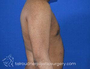 Male Breast Reduction (Gynecomastia)