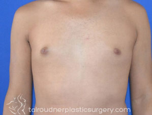 Male Breast Reduction (Gynecomastia)