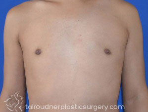Male Breast Reduction (Gynecomastia)