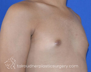 Male Breast Reduction (Gynecomastia)
