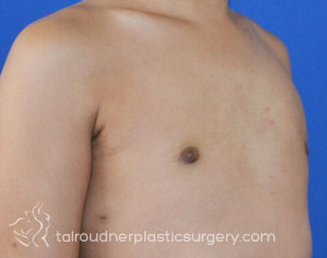 Male Breast Reduction (Gynecomastia)