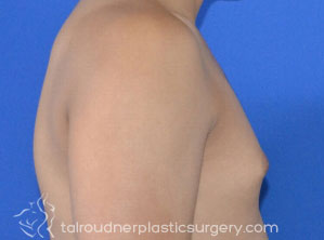 Male Breast Reduction (Gynecomastia)