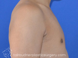 Male Breast Reduction (Gynecomastia)